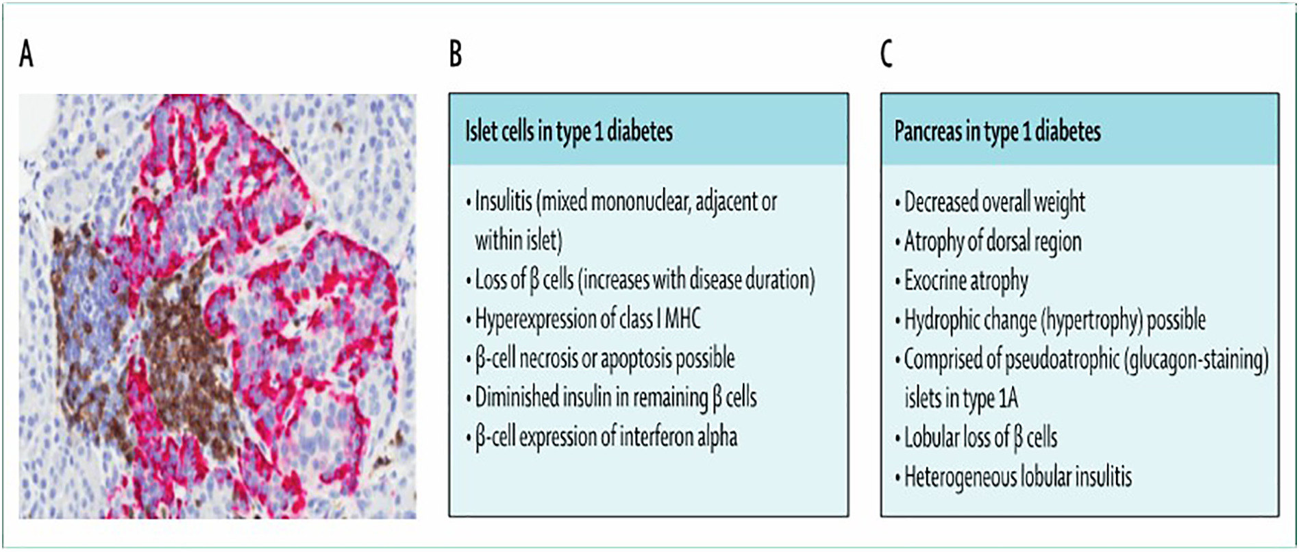 1型糖尿病胰腺的病理特征 1型糖尿病胰腺的病理特征