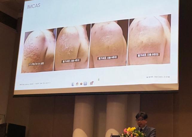 韓國Miracell在國際美容整形外科宣布用干細(xì)胞療法治愈銀屑病 韓國Miracell在國際美容整形外科宣布用干細(xì)胞療法治愈銀屑病