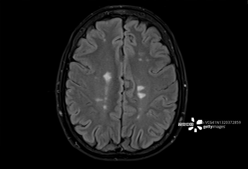 多發(fā)性腦硬化癥的磁共振成像，軸位Flair視圖