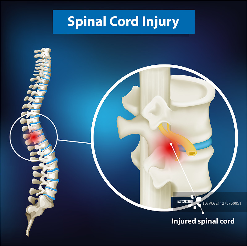 間充質(zhì)干細胞治療脊髓損傷的臨床應(yīng)用 間充質(zhì)干細胞治療脊髓損傷的臨床應(yīng)用