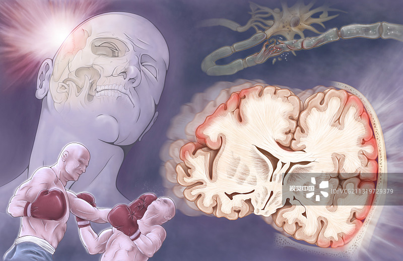 間充質(zhì)干細(xì)胞治療創(chuàng)傷性腦損傷的臨床進(jìn)展 間充質(zhì)干細(xì)胞治療創(chuàng)傷性腦損傷的臨床進(jìn)展