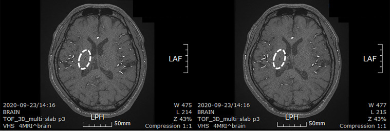 圖4：微創(chuàng)人臍帶間充質(zhì)干細胞移植后患者的腦部計算機斷層掃描圖像。
