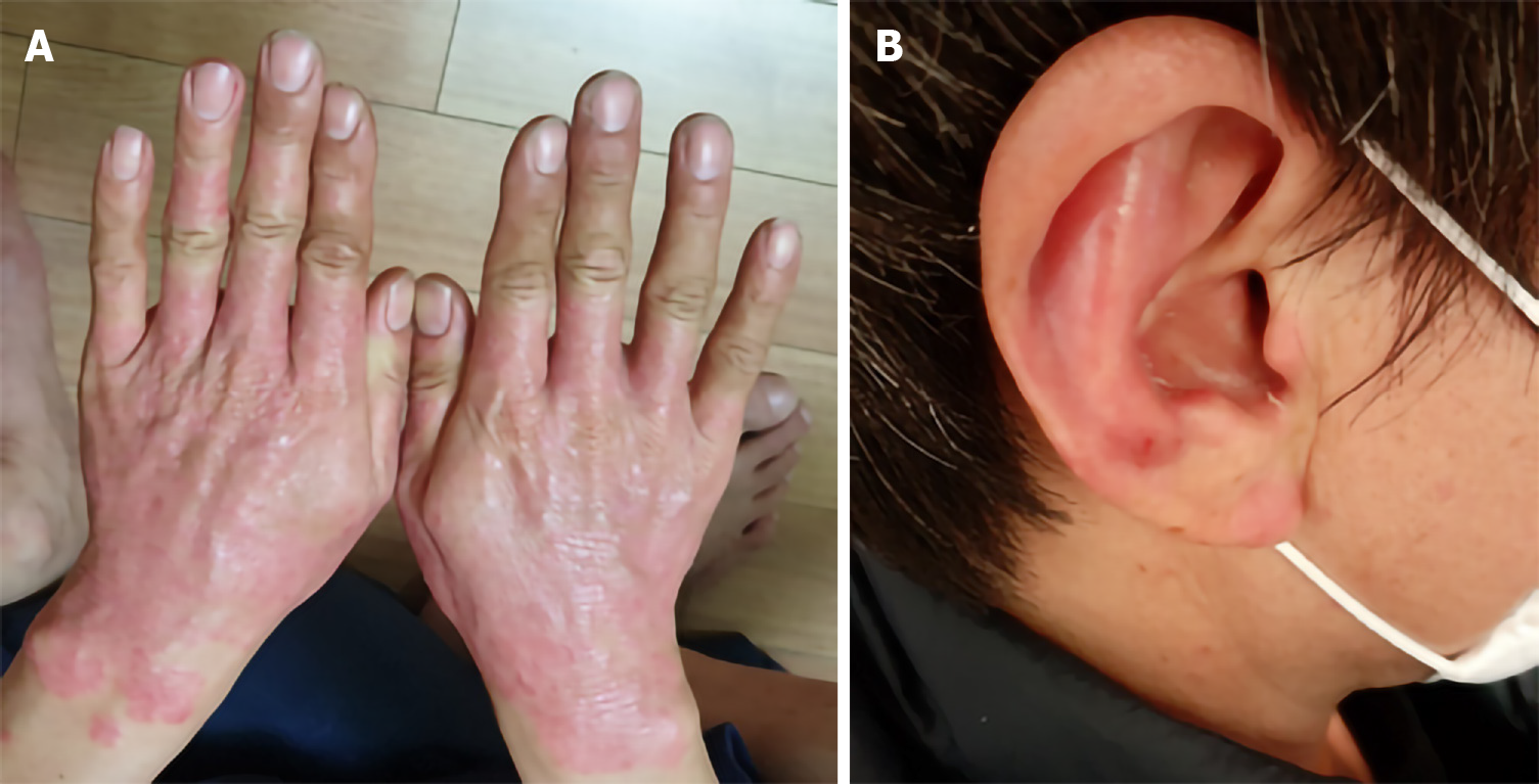 圖1：銀屑病治療前皮損部位。