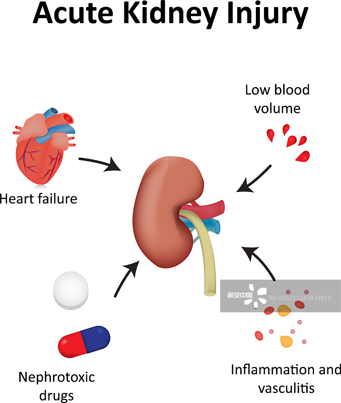 間充質(zhì)干細(xì)胞治療急性腎損傷的臨床研究進(jìn)展 間充質(zhì)干細(xì)胞治療急性腎損傷的臨床研究進(jìn)展