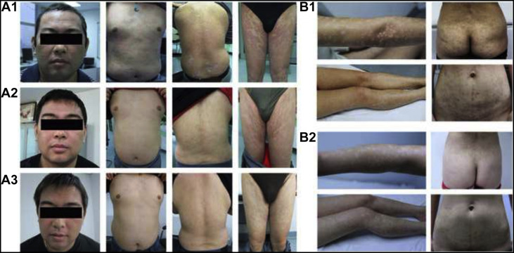 間充質(zhì)干細(xì)胞治療銀屑病的臨床案例 間充質(zhì)干細(xì)胞治療銀屑病的臨床案例