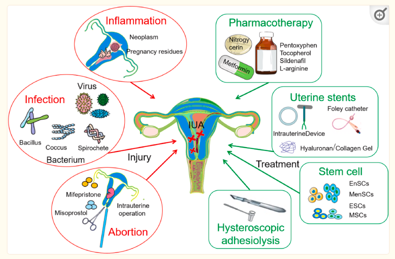 圖1：子宮內(nèi)膜損傷的機(jī)制及主要治療策略。