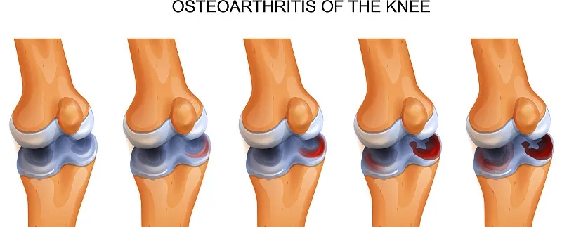 干細胞修復撕裂的無血管半月板軟骨:從體外優(yōu)化到首次人體研究
