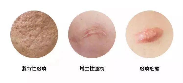根據(jù)瘢痕的顏色、質(zhì)地和形態(tài)，臨床可以將瘢痕分為三大類：萎縮性瘢痕、增生性瘢痕和瘢痕疙瘩。