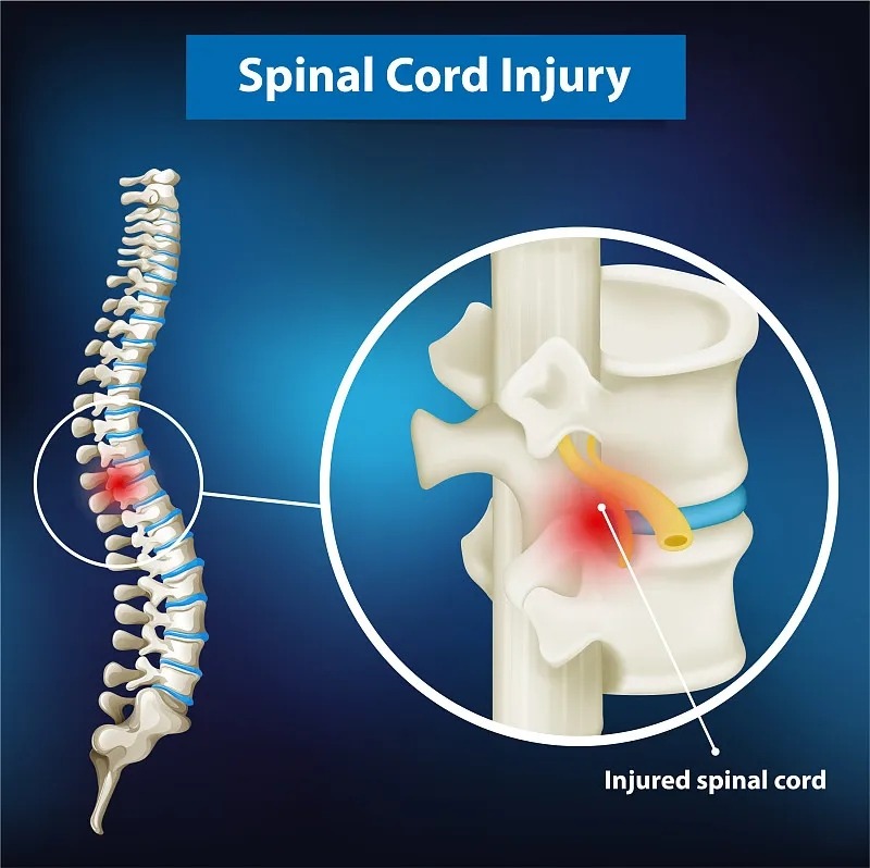 脊髓損傷的癥狀及原因丨如何管理和治療 脊髓損傷的癥狀及原因丨如何管理和治療