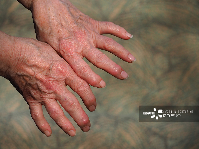 研究為治療類風濕性關(guān)節(jié)炎開辟了新的治療途徑