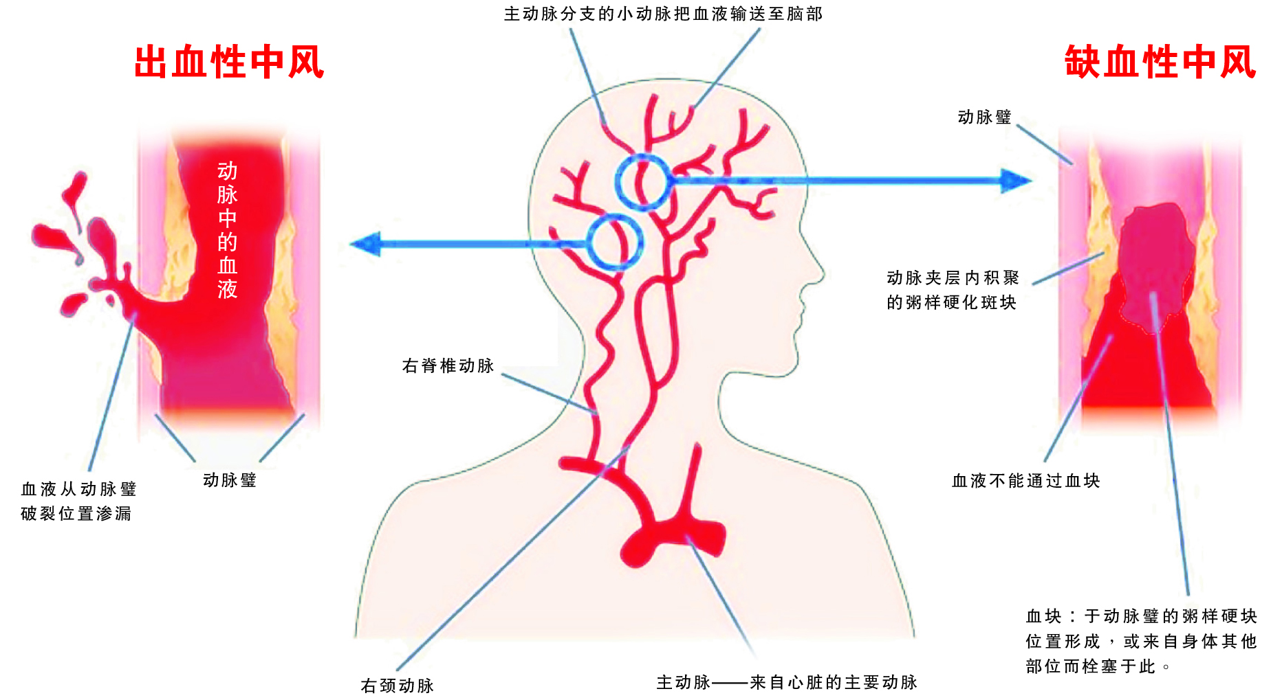 干細(xì)胞治療腦卒中的臨床試驗(yàn)研究進(jìn)展