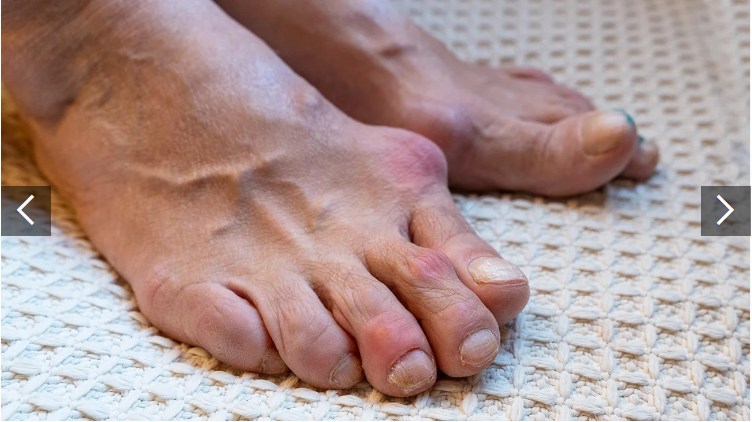 類(lèi)風(fēng)濕關(guān)節(jié)炎癥狀