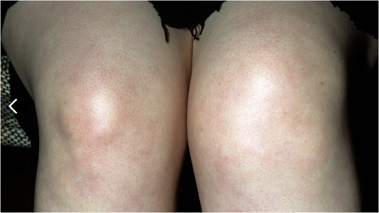 類(lèi)風(fēng)濕關(guān)節(jié)炎癥狀