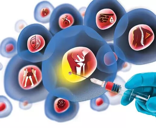 干細(xì)胞治療糖尿病的流程 干細(xì)胞治療糖尿病的流程