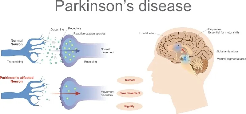 什么是帕金森病的再生醫(yī)學(xué) 什么是帕金森病的再生醫(yī)學(xué)