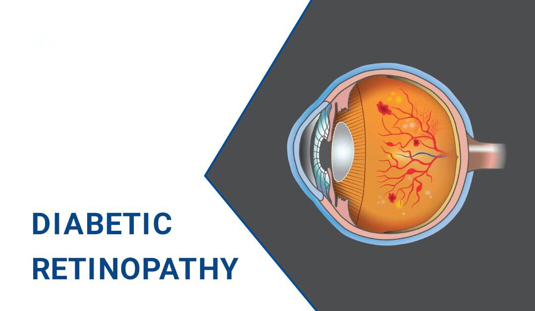 糖尿病視網(wǎng)膜病變–原因、階段和治療