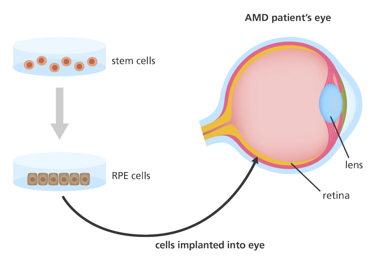插圖顯示干細胞如何用于產(chǎn)生可用于治療年齡相關性黃斑變性 (AMD) 患者的視網(wǎng)膜色素上皮 (RPE) 細胞