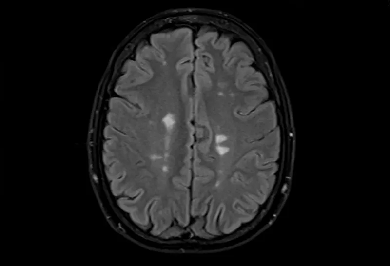 多發(fā)性腦硬化癥的磁共振成像，軸位Flair視圖