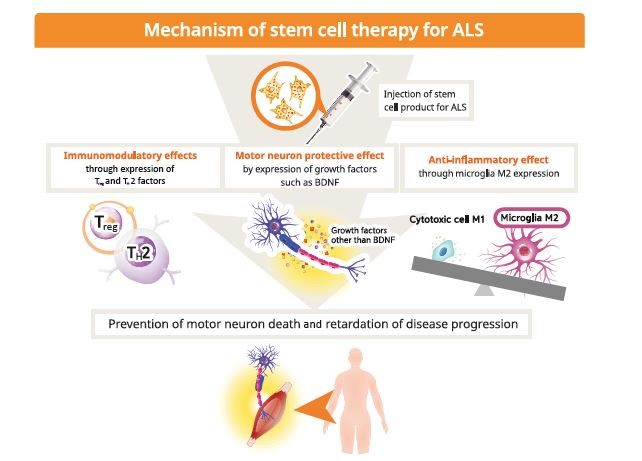 干細胞療法用于治療肌萎縮側索硬化癥（ALS）。