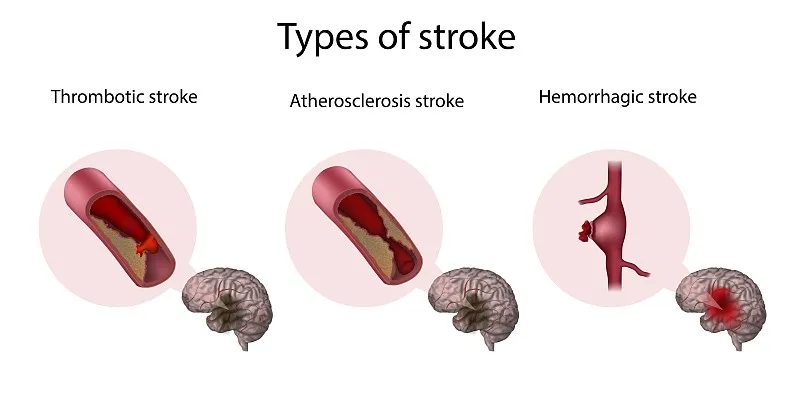 系統(tǒng)評估干細胞療法治療缺血性中風的安全性及可行性 系統(tǒng)評估干細胞療法治療缺血性中風的安全性及可行性