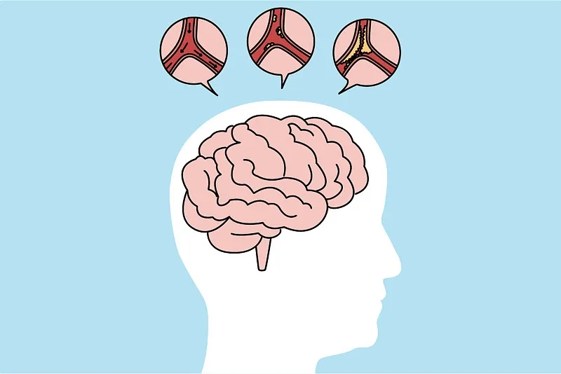 通過比較6、12、24個月的結(jié)果，來評估干細胞治療缺血性中風(fēng)的有效性和安全性