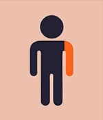 單癱型腦癱影響一側(cè)肢體，通常是手臂。