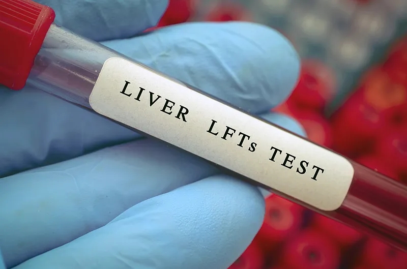 診斷酒精相關(guān)的肝病 診斷酒精相關(guān)的肝病