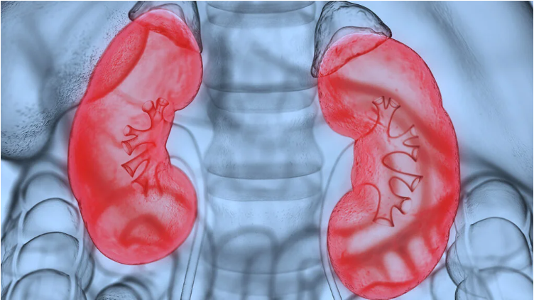 什么是腎病綜合征？癥狀和治療