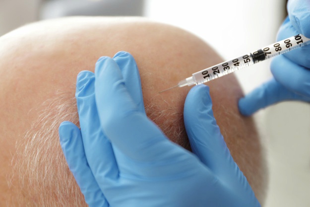 頭發(fā)修復(fù)過(guò)程是怎樣的？ |  干細(xì)胞治療脫發(fā)