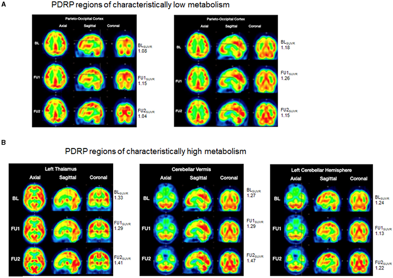 圖3：FDG-PET掃描