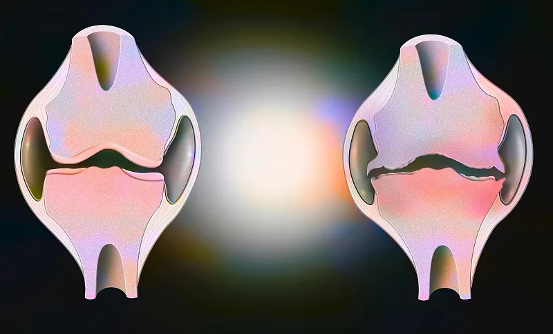 盤點:2020~2023年干細胞治療骨關(guān)節(jié)炎的臨床研究進展 盤點:2020~2023年干細胞治療骨關(guān)節(jié)炎的臨床研究進展