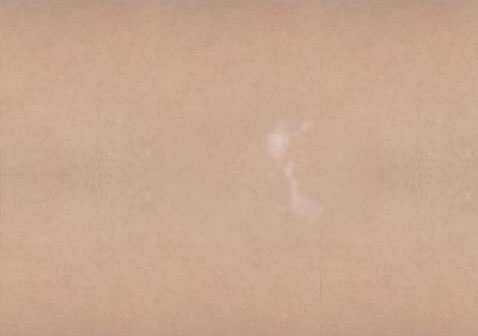 白癜風(fēng)白斑初期癥狀輕微小斑點(diǎn)，無(wú)色素。