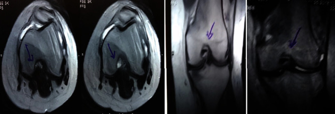 圖1：治療前MRI顯示內(nèi)側(cè)和外側(cè)半月板后角的III級撕裂。