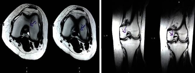 圖2：治療后MRI顯示內(nèi)側(cè)和外側(cè)半月板后角的撕裂有所改善?；颊呓?jīng)歷了癥狀改善以及進(jìn)行日常生活活動的能力增強(qiáng)。