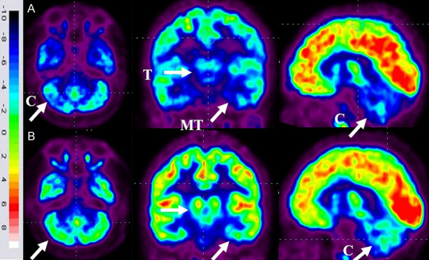 圖6：ASD患者在細(xì)胞治療前和細(xì)胞治療后6個(gè)月進(jìn)行的FDG-PET/CT大腦掃描的代表性圖像。
