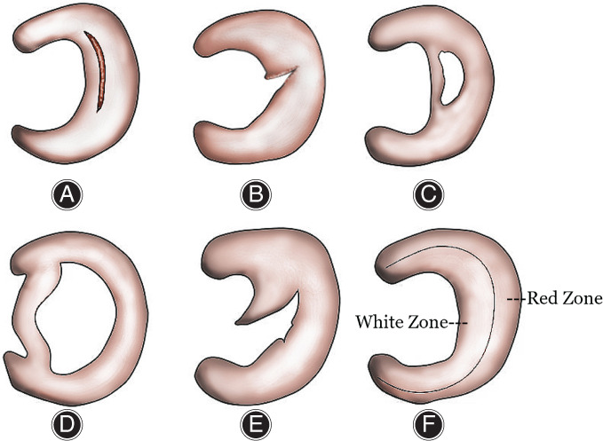 圖2：半月板的解剖結(jié)構(gòu)和損傷類型