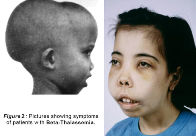 重型β地中海貧血是一種嚴重的遺傳性疾病，給患兒帶來了長期的痛苦和折磨