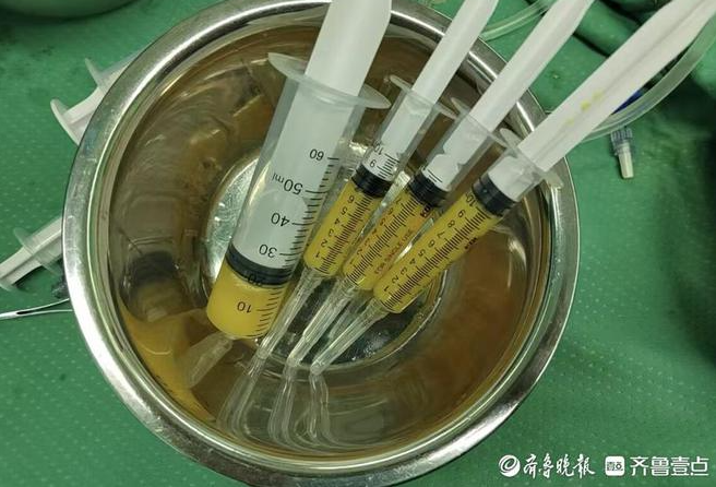 孫濤主任采用的自體脂肪微片段治療術(shù)，為她的治療帶來(lái)了新的轉(zhuǎn)機(jī)