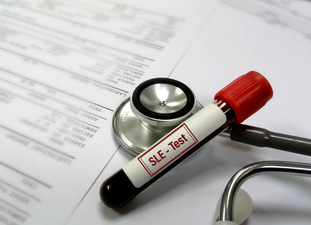 臍帶干細(xì)胞可以幫助狼瘡患者嗎？