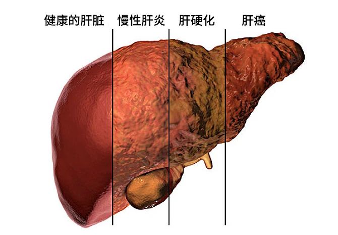 不同原因的肝損害發(fā)展主要分為三個(gè)階段：肝炎-肝硬化-肝癌。