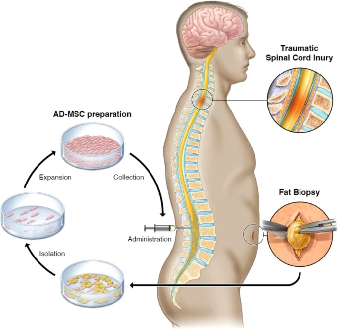 通過活檢、AD-MSC 分離、擴增和收集以及治療管理來獲取脂肪的過程圖解