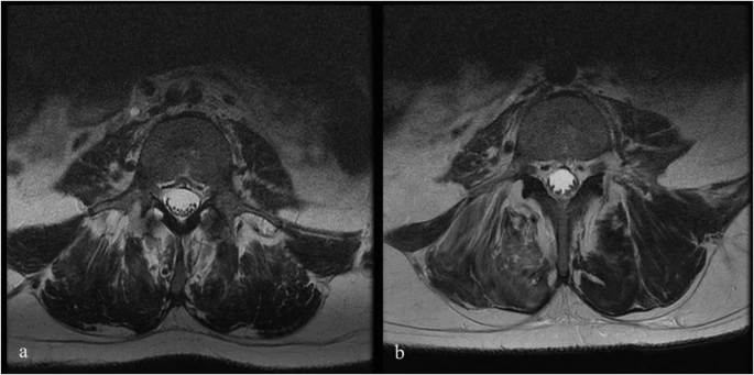 圖1：6號患者輸注前和輸注后MRI。