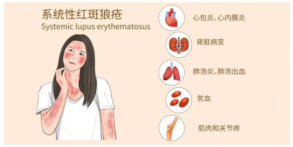 什么是系統(tǒng)性紅斑狼瘡？