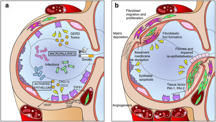 圖1：IPF發(fā)病機(jī)制示意圖。