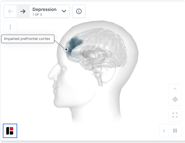 重度抑郁癥的特征