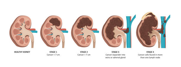 你了解急性腎損傷的3個不同階段嗎？