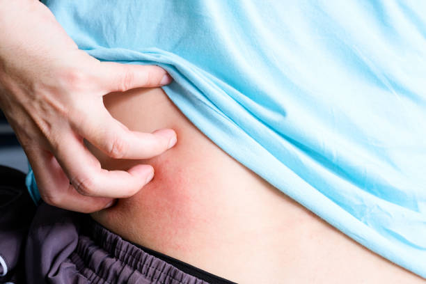 肝硬化肝腎綜合征的診斷、預(yù)防和治療