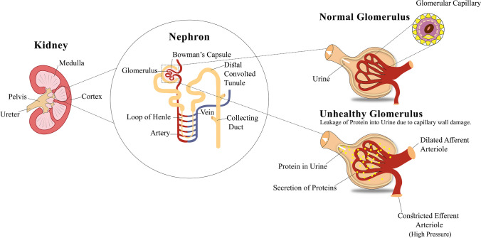 圖1：導致糖尿病腎病的原因，即糖尿病引起的腎臟疾病