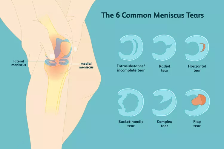 膝關(guān)節(jié)半月板損傷：你了解這六種撕裂類型嗎？