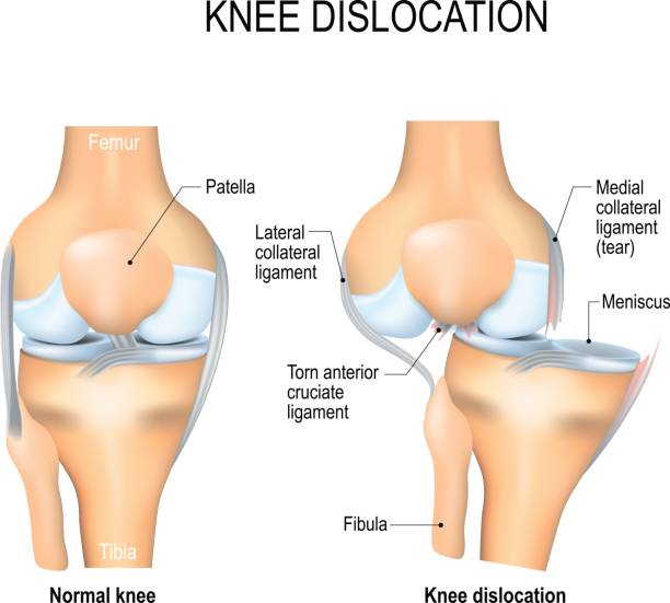 半月板撕裂后該如何恢復(fù)? 半月板撕裂后該如何恢復(fù)?